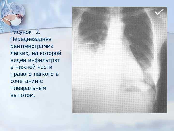 Рисунок -2. Переднезадняя рентгенограмма легких, на которой виден инфильтрат в нижней части правого легкого