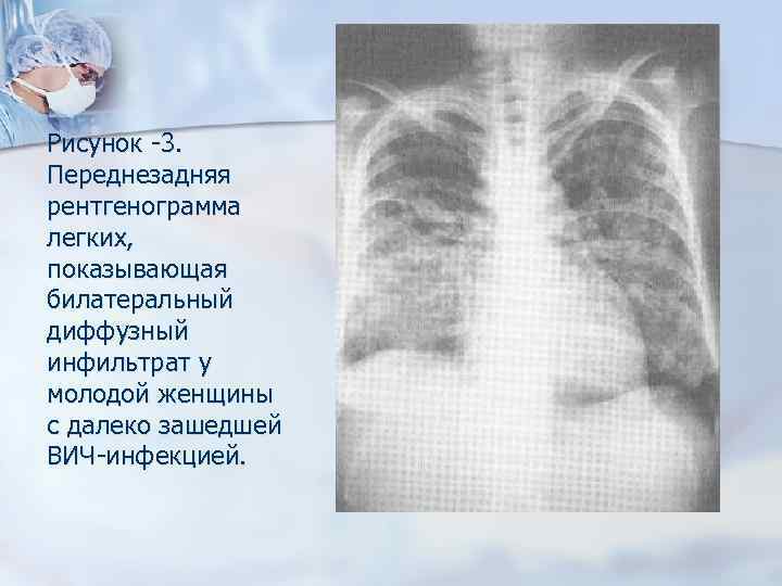 Рисунок -3. Переднезадняя рентгенограмма легких, показывающая билатеральный диффузный инфильтрат у молодой женщины с далеко