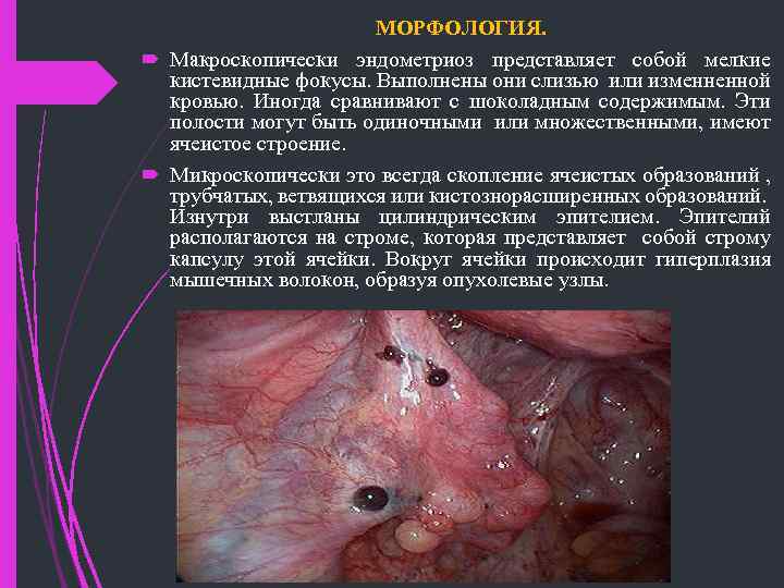 МОРФОЛОГИЯ. Макроскопически эндометриоз представляет собой мелкие кистевидные фокусы. Выполнены они слизью или изменненной кровью.