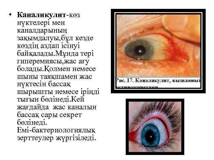  • Каналикулит-көз нүктелері мен каналдарының зақымдалуы, бұл кезде көздің аздап ісінуі байқалады. Мұнда