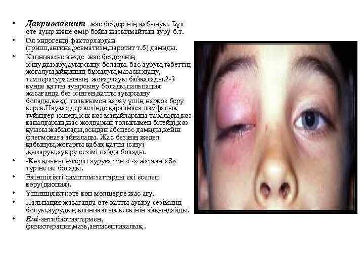  • • Дакриоаденит -жас бездерінің қабынуы. Бұл өте ауыр және өмір бойы жазылмайтын