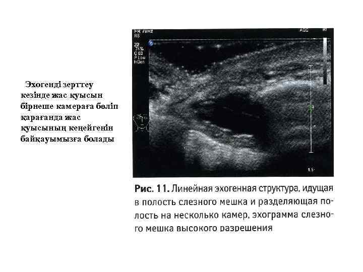 Эхогенді зерттеу кезінде жас қуысын бірнеше камераға бөліп қарағанда жас қуысының кеңейгенін байқауымызға болады
