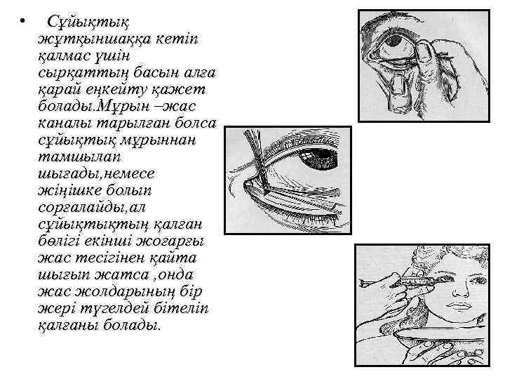  • Сұйықтық жұтқыншаққа кетіп қалмас үшін сырқаттың басын алға қарай еңкейту қажет болады.