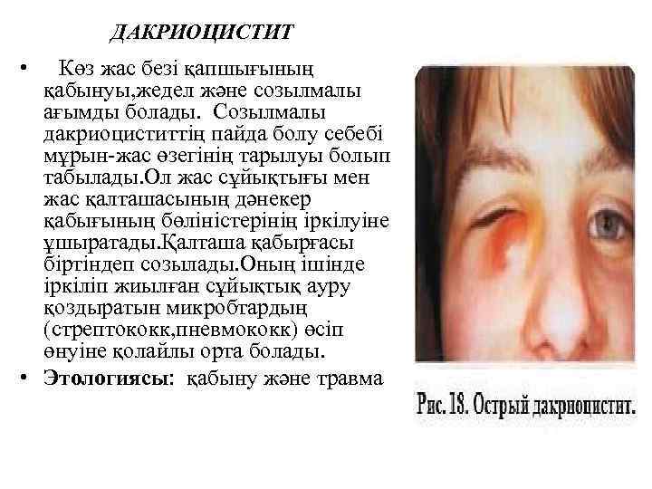ДАКРИОЦИСТИТ • Көз жас безі қапшығының қабынуы, жедел және созылмалы ағымды болады. Созылмалы дакриоциститтің