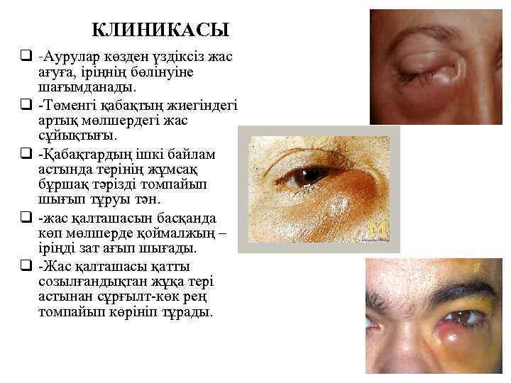 КЛИНИКАСЫ q -Аурулар көзден үздіксіз жас ағуға, іріңнің бөлінуіне шағымданады. q -Төменгі қабақтың жиегіндегі