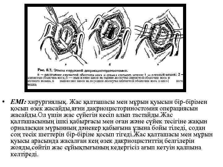  • ЕМІ: хирургиялық. Жас қалташасы мен мұрын қуысын бір-бірімен қосып өзек жасайды, яғни