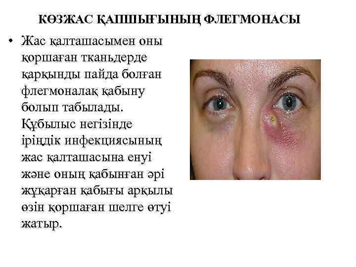 КӨЗЖАС ҚАПШЫҒЫНЫҢ ФЛЕГМОНАСЫ • Жас қалташасымен оны қоршаған тканьдерде қарқынды пайда болған флегмоналақ қабыну
