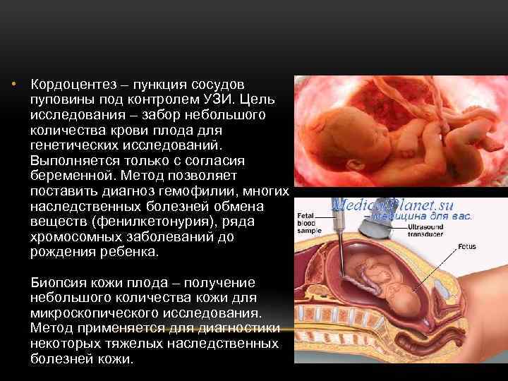  • Кордоцентез – пункция сосудов пуповины под контролем УЗИ. Цель исследования – забор