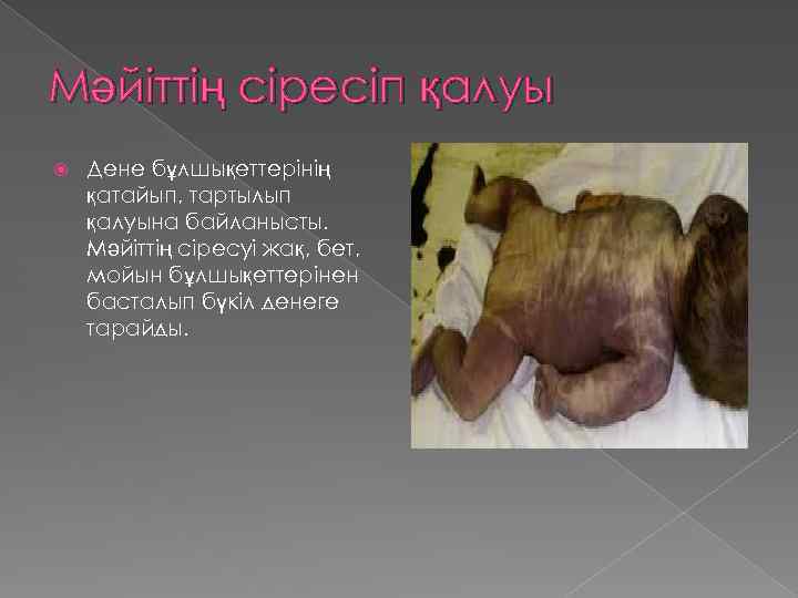Мәйіттің сіресіп қалуы Дене бұлшықеттерінің қатайып, тартылып қалуына байланысты. Мәйіттің сіресуі жақ, бет, мойын