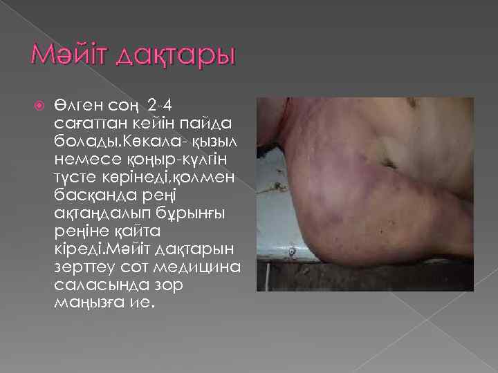 Мәйіт дақтары Өлген соң 2 -4 сағаттан кейін пайда болады. Көкала- қызыл немесе қоңыр-күлгін