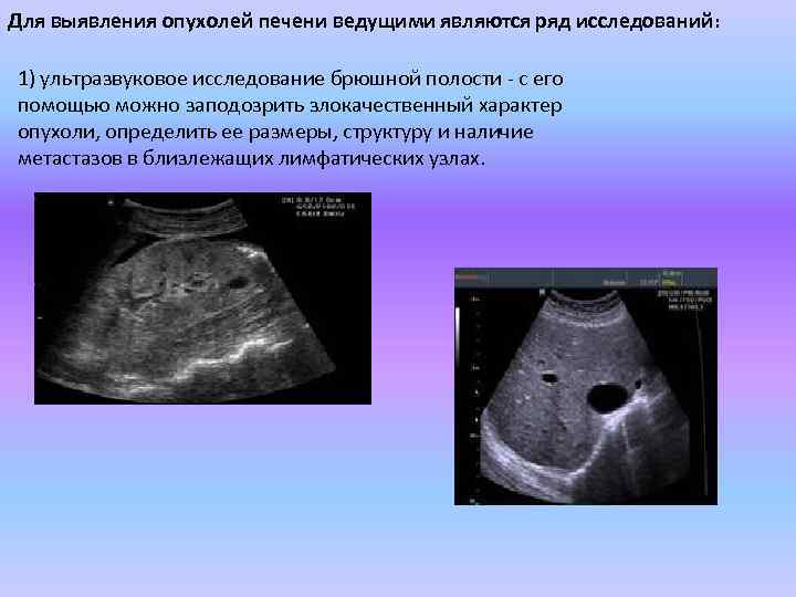 Для выявления опухолей печени ведущими являются ряд исследований: 1) ультразвуковое исследование брюшной полости -