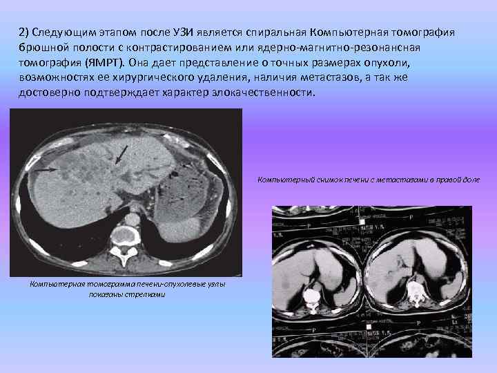 2) Следующим этапом после УЗИ является спиральная Компьютерная томография брюшной полости с контрастированием или