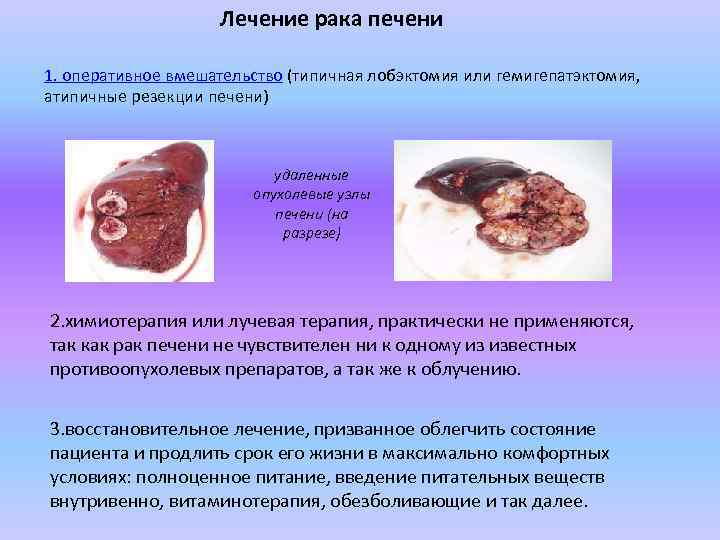 Лечение рака печени 1. оперативное вмешательство (типичная лобэктомия или гемигепатэктомия, атипичные резекции печени) удаленные