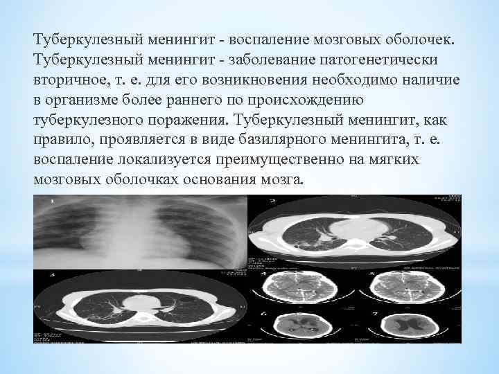 Туберкулезный менингит - воспаление мозговых оболочек. Туберкулезный менингит - заболевание патогенетически вторичное, т. е.