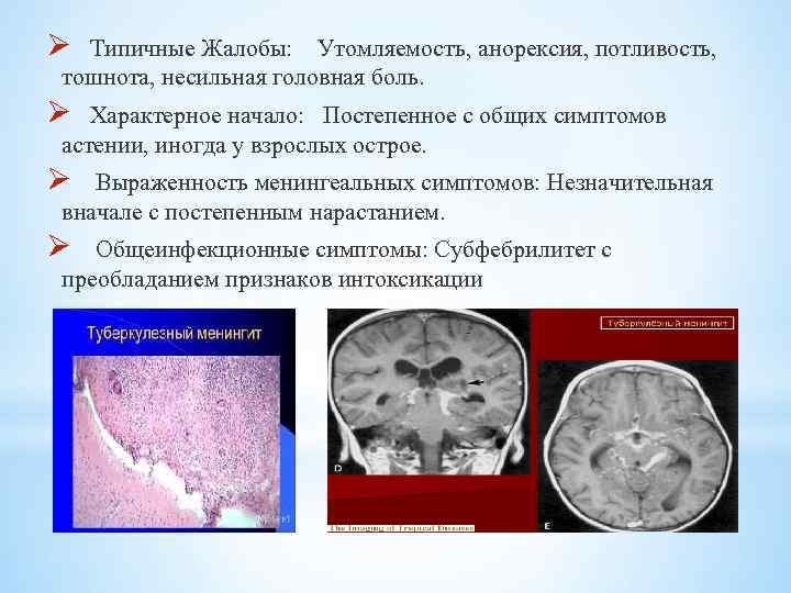 Ø Типичные Жалобы: Утомляемость, анорексия, потливость, тошнота, несильная головная боль. Ø Характерное начало: Постепенное