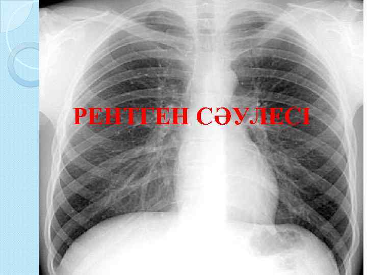 РЕНТГЕН СӘУЛЕСІ 