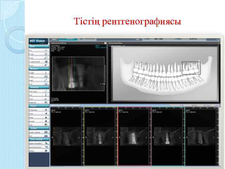 Тістің рентгенографиясы 