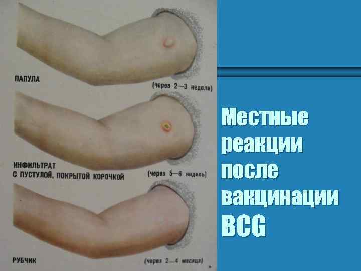 Местные реакции после вакцинации BCG 