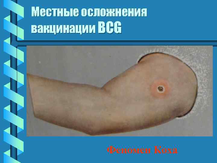 Местные осложнения вакцинации BCG Феномен Коха 