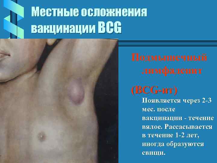 Местные осложнения вакцинации BCG Подмышечный лимфаденит (BCG-ит) Появляется через 2 -3 мес. после вакцинации