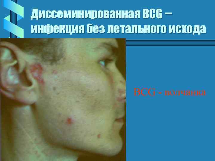 Диссеминированная BCG – инфекция без летального исхода BCG - волчанка 