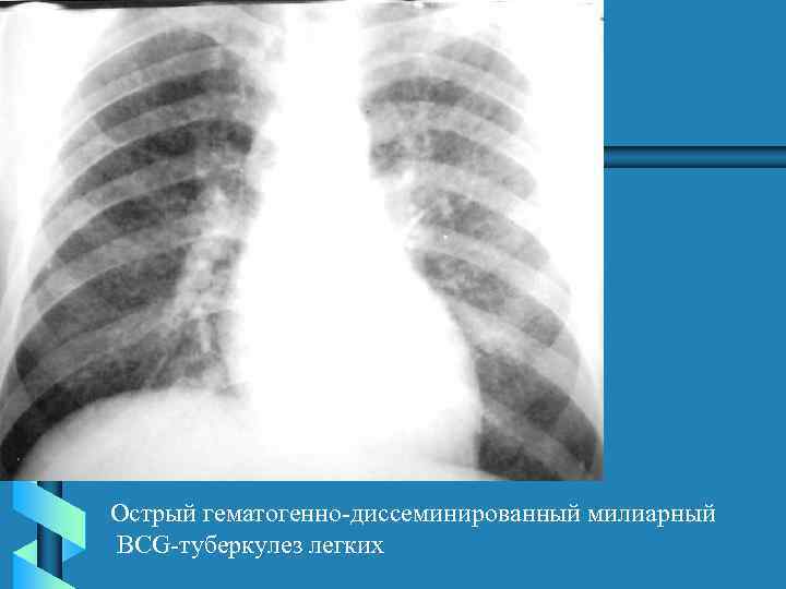 Острый гематогенно-диссеминированный милиарный BCG-туберкулез легких 
