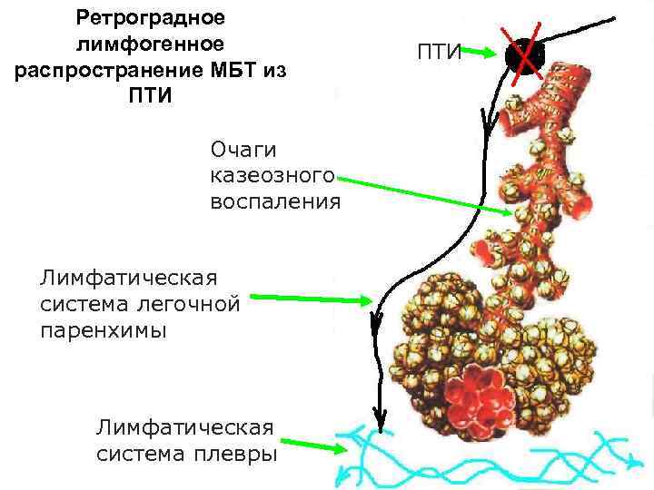 Ретроградное лимфогенное распространение МБТ из ПТИ Очаги казеозного воспаления Лимфатическая система легочной паренхимы Лимфатическая