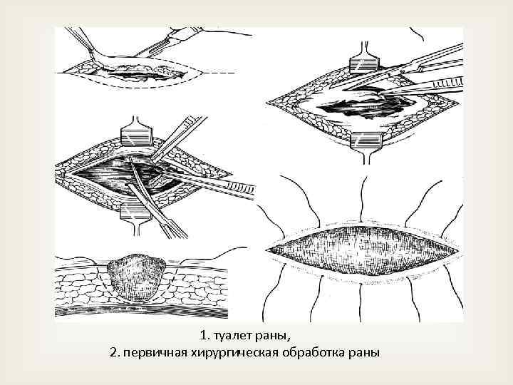 Раны пхо ран. Перевязка РАН гнойных РАН. Туалет раны и первичная хирургическая обработка Пхо раны. Первичный туалет ожоговой раны. Пхо РАН дренирование РАН.