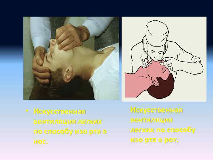  • Искусственная вентиляция легких по способу изо рта в нос. Искусственная вентиляция легких