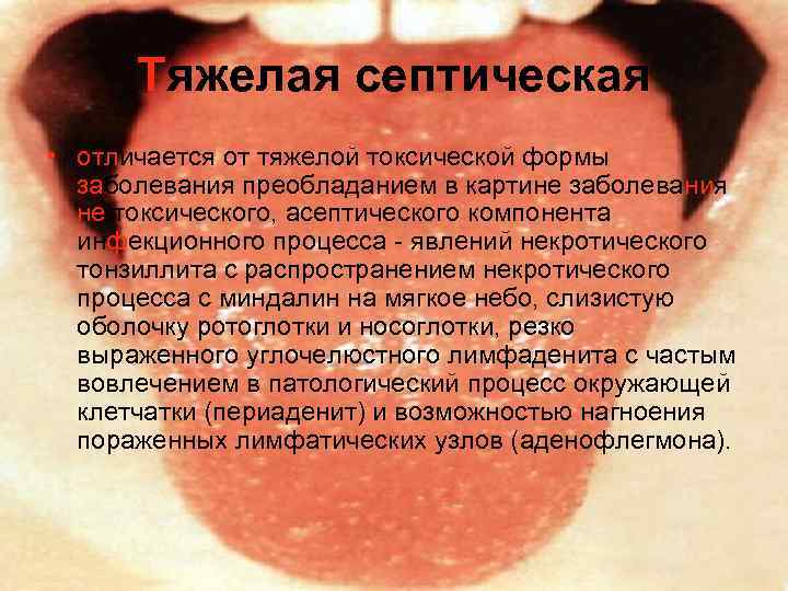 Тяжелая септическая • отличается от тяжелой токсической формы заболевания преобладанием в картине заболевания не