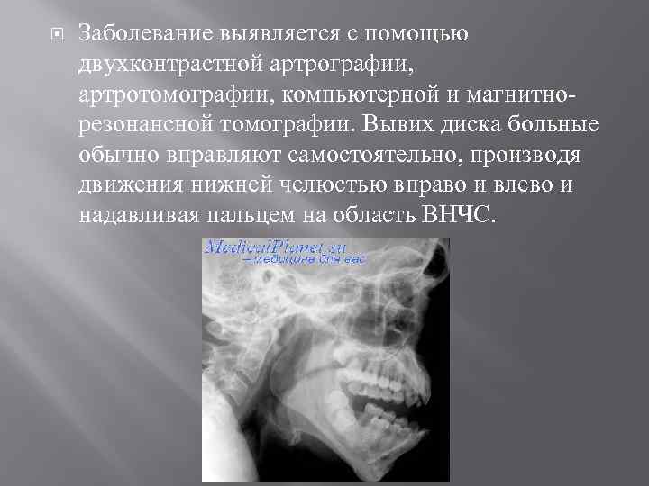  Заболевание выявляется с помощью двухконтрастной артрографии, артротомографии, компьютерной и магнитнорезонансной томографии. Вывих диска