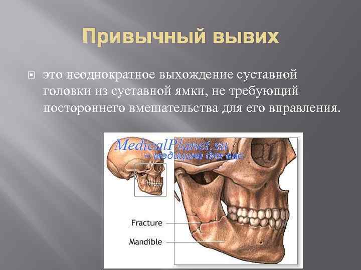 Привычный вывих это неоднократное выхождение суставной головки из суставной ямки, не требующий постороннего вмешательства