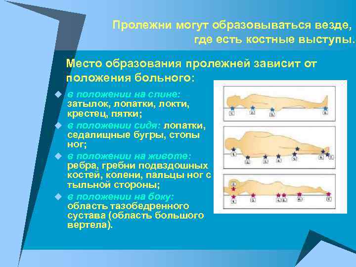 Пролежни могут образовываться везде, где есть костные выступы. Место образования пролежней зависит от положения