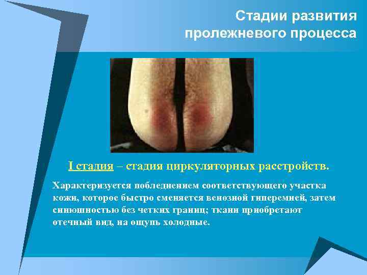 Стадии развития пролежневого процесса I стадия – стадия циркуляторных расстройств. Характеризуется побледнением соответствующего участка