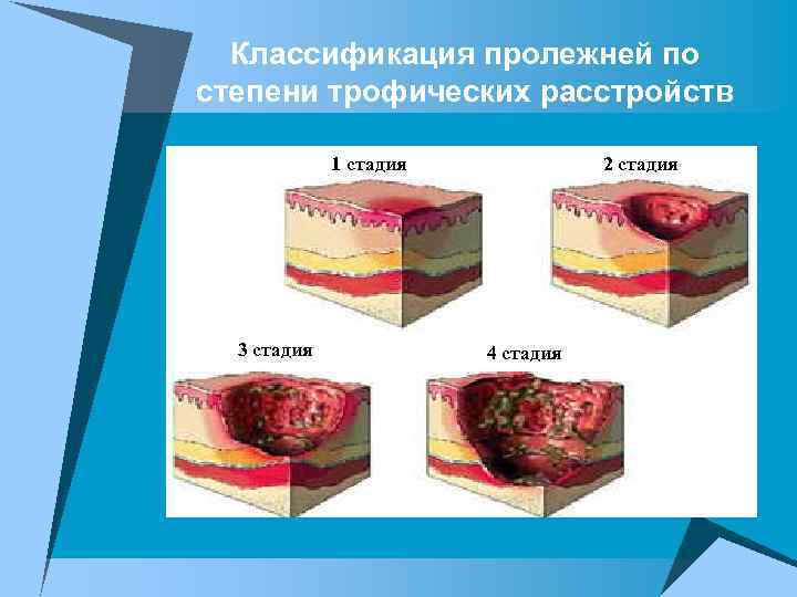 Классификация пролежней по степени трофических расстройств 1 стадия 3 стадия 2 стадия 4 стадия