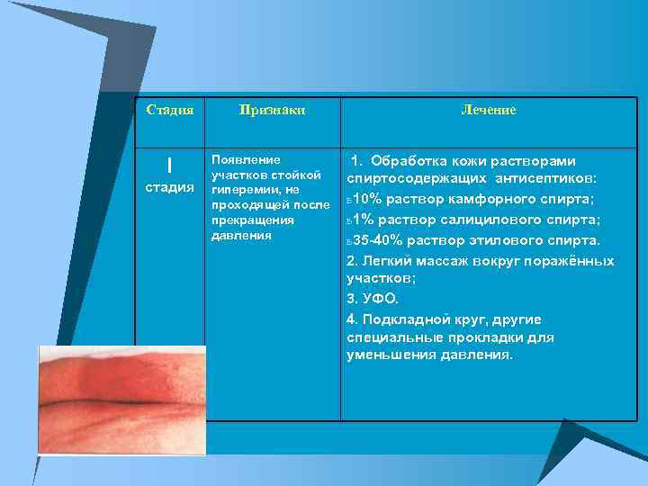 Стадия Признаки I Появление участков стойкой гиперемии, не проходящей после прекращения давления стадия Лечение
