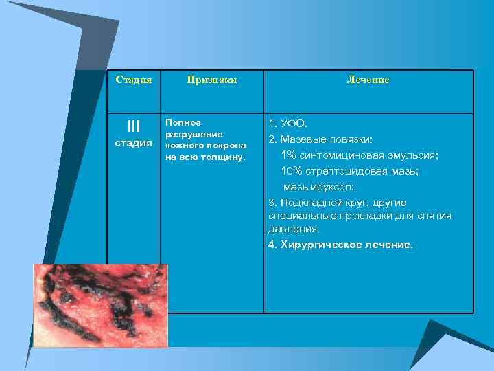 Стадия III стадия Признаки Полное разрушение кожного покрова на всю толщину. Лечение 1. УФО.