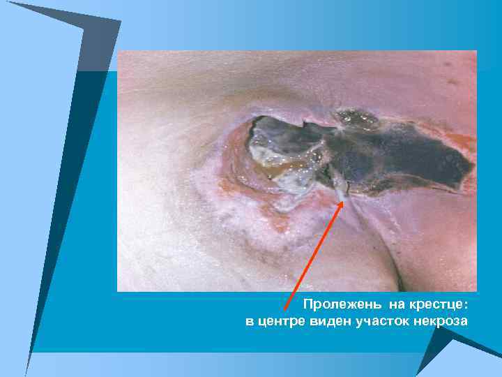Пролежень на крестце: в центре виден участок некроза 