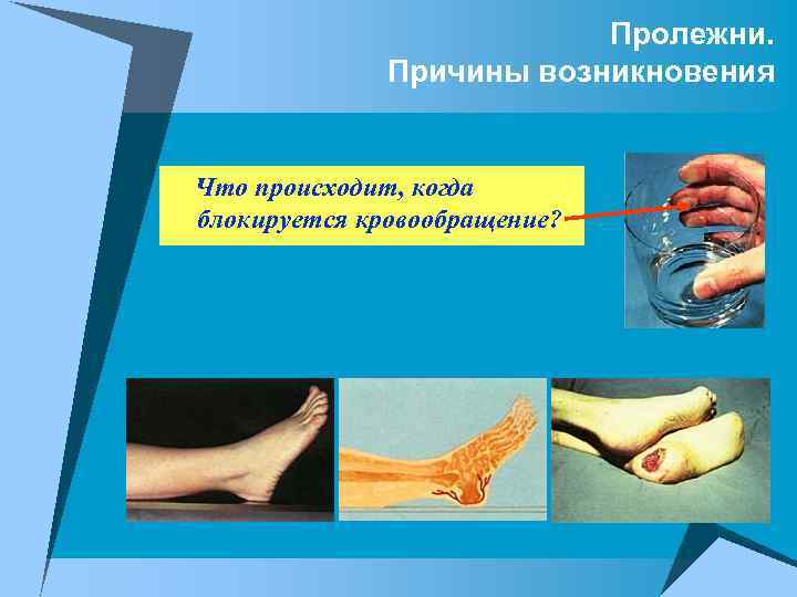Пролежни. Причины возникновения Что происходит, когда блокируется кровообращение? 