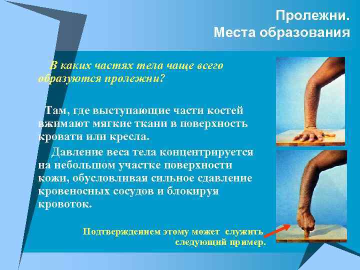 Пролежни. Места образования В каких частях тела чаще всего образуются пролежни? Там, где выступающие