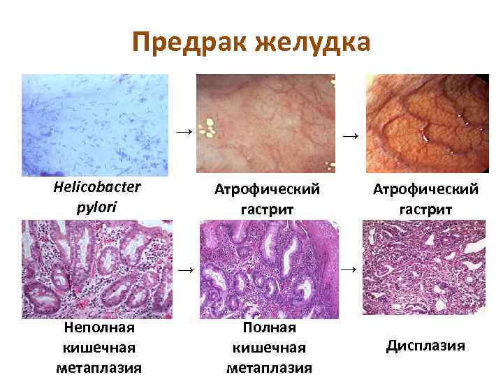 Предрак желудка → Helicobacter pylori → Атрофический гастрит → → Неполная кишечная метаплазия Атрофический