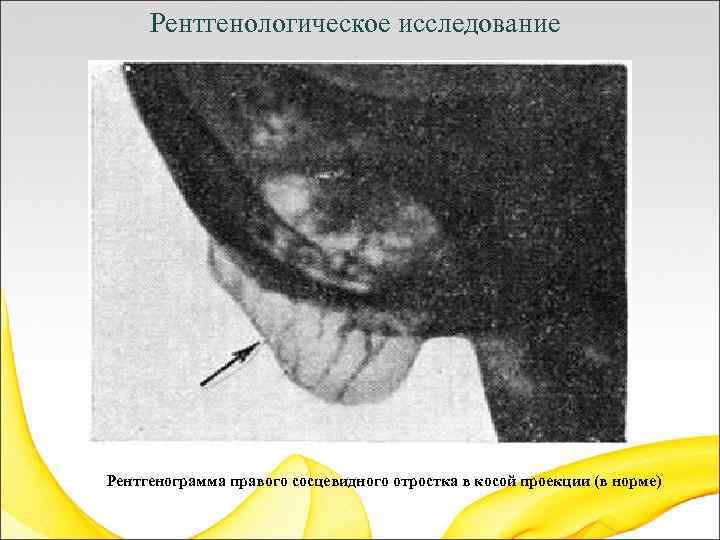 Рентгенологическое исследование Рентгенограмма правого сосцевидного отростка в косой проекции (в норме) 
