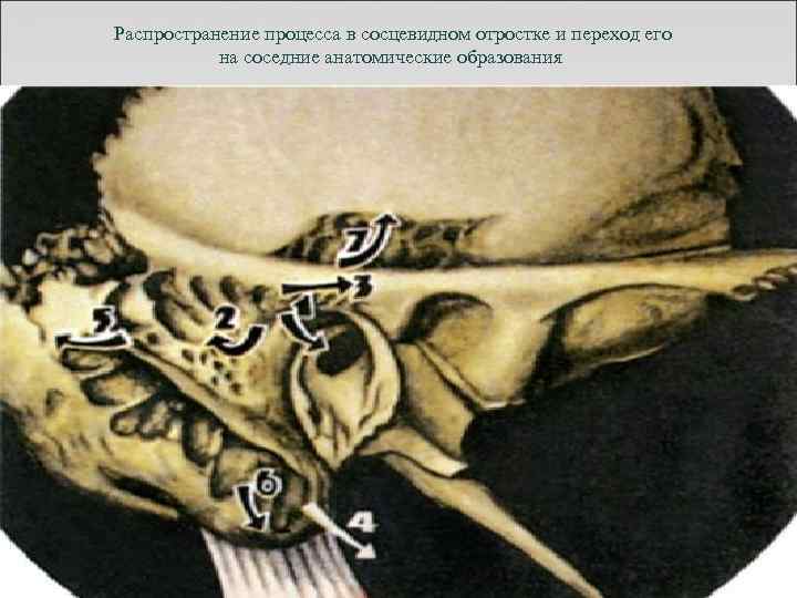 Распространение процесса в сосцевидном отростке и переход его на соседние анатомические образования 