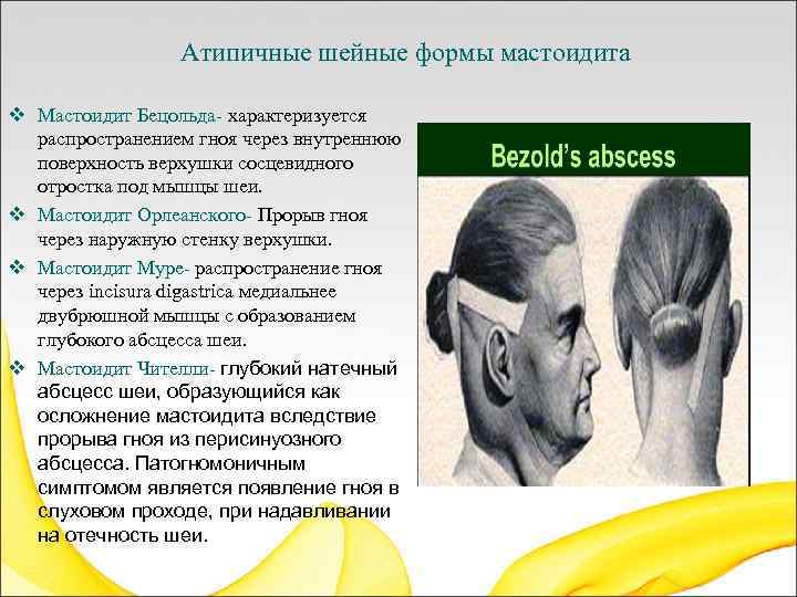  Атипичные шейные формы мастоидита v Мастоидит Бецольда- характеризуется распространением гноя через внутреннюю поверхность