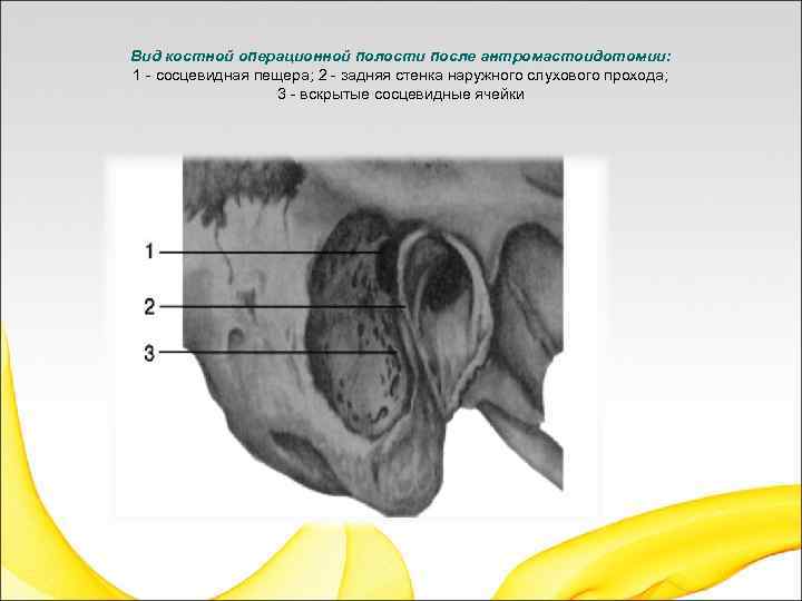 Вид костной операционной полости после антромастоидотомии: 1 - сосцевидная пещера; 2 - задняя стенка