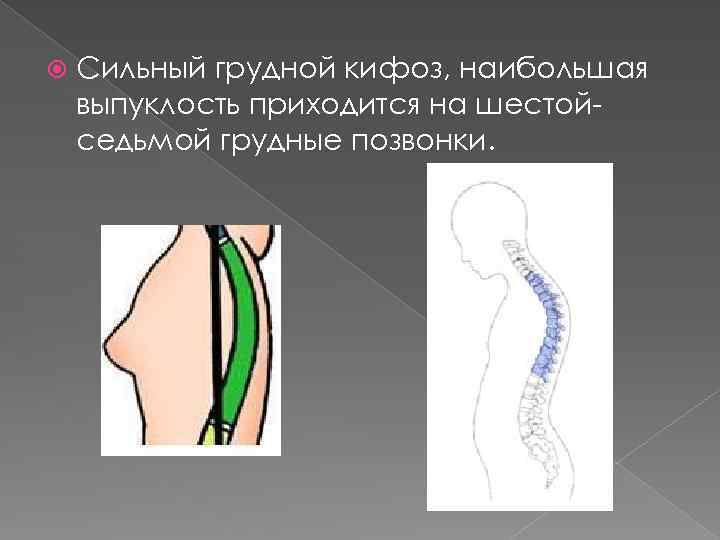  Сильный грудной кифоз, наибольшая выпуклость приходится на шестойседьмой грудные позвонки. 