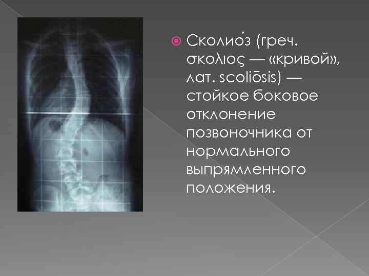  Сколио з (греч. σκολιός — «кривой» , лат. scoliōsis) — стойкое боковое отклонение