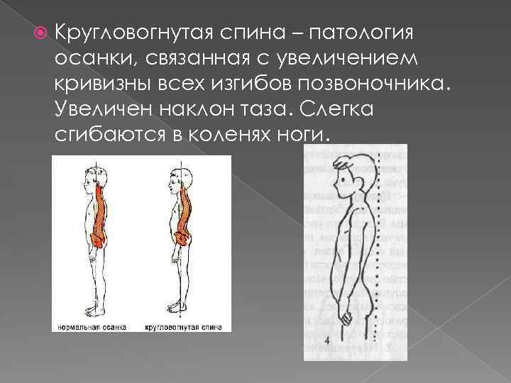  Кругловогнутая спина – патология осанки, связанная с увеличением кривизны всех изгибов позвоночника. Увеличен