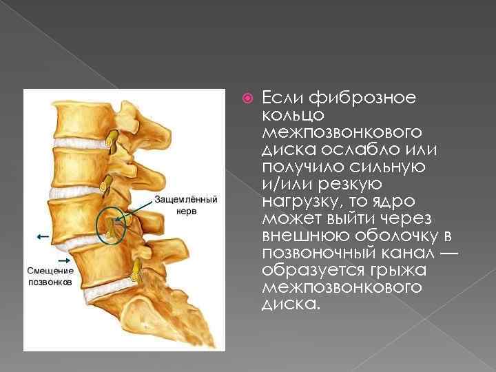  Если фиброзное кольцо межпозвонкового диска ослабло или получило сильную и/или резкую нагрузку, то