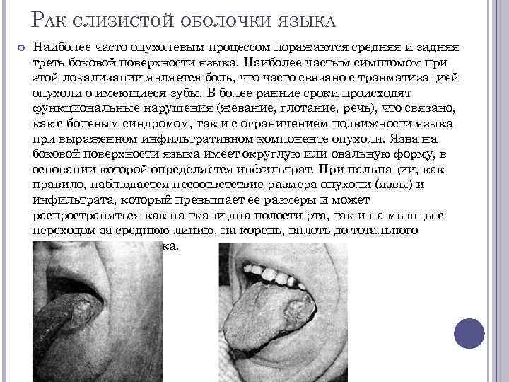 РАК СЛИЗИСТОЙ ОБОЛОЧКИ ЯЗЫКА Наиболее часто опухолевым процессом поражаются средняя и задняя треть боковой